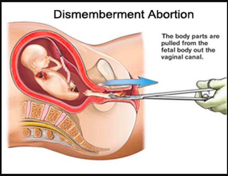 aborto per smembramento