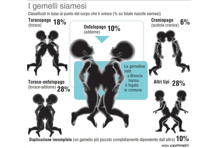 La Buona Notizia #755 – Nate in Italia due gemelle siamesi 1